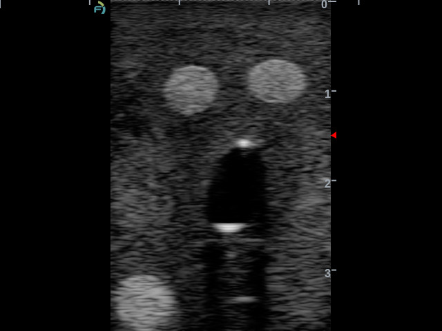 Gphantom Anestesia - Imagem 6