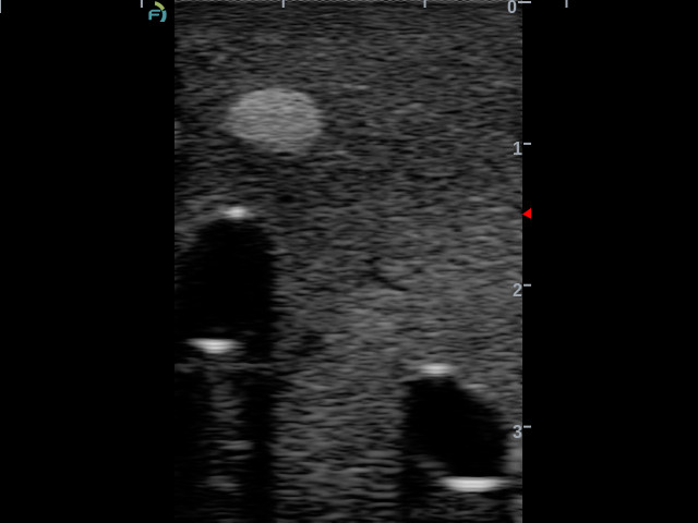Gphantom Anestesia - Imagem 8